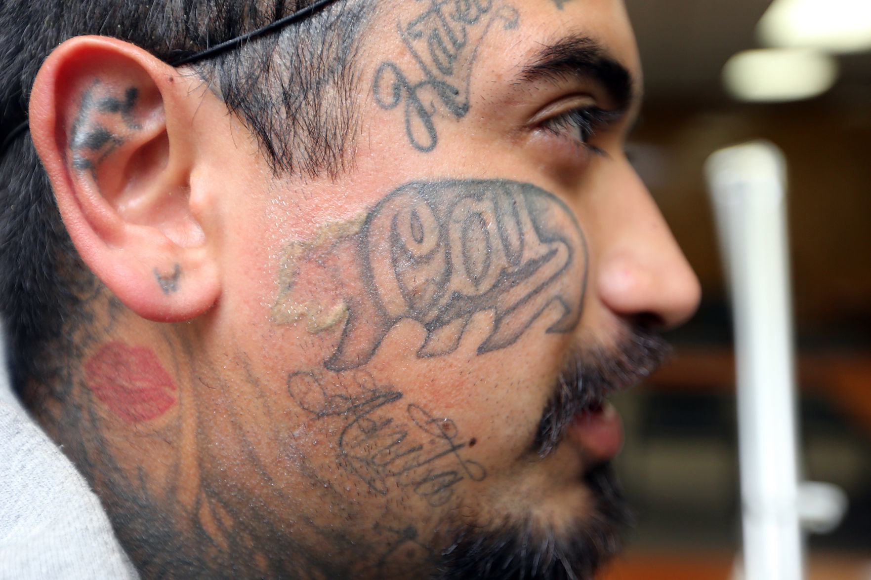 Tattoo Removal
